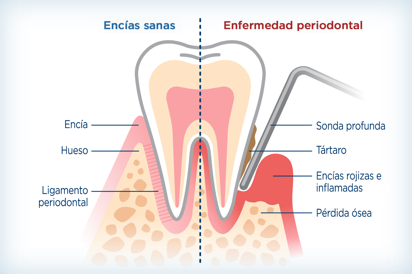 Infografía que muestra la diferencia entre las encías sanas y las encías con enfermedad periodontal.